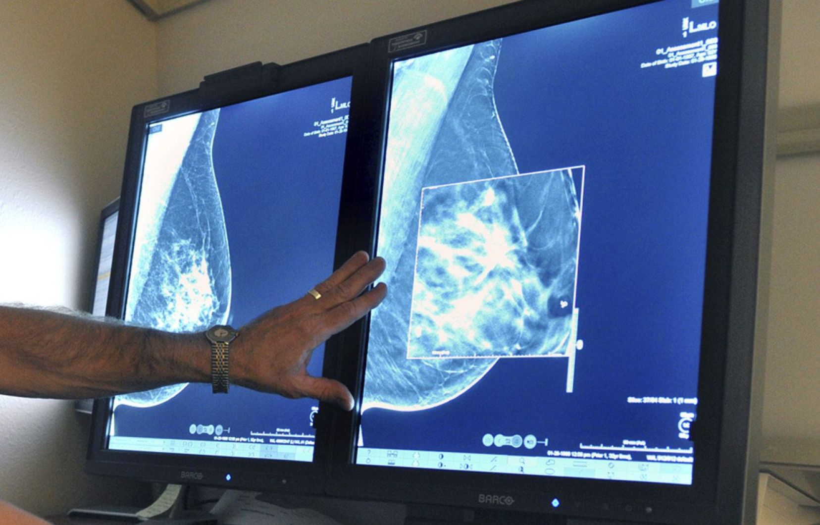 Toward a new home test to find out the risk of breast cancer